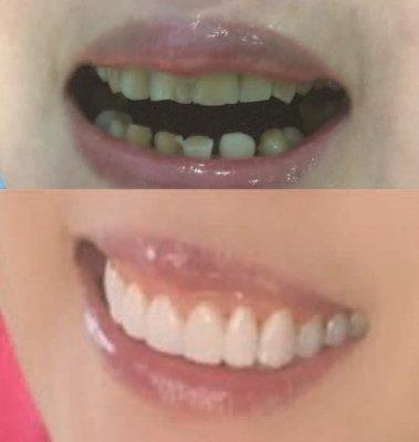 Complete full mouth transformation with porcelain veneers and zirconia crowns