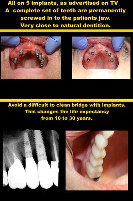 All on 5 Implants & Avoid a Difficult to Clean Bridge with Implants