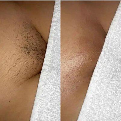 Brazilian wax before & after