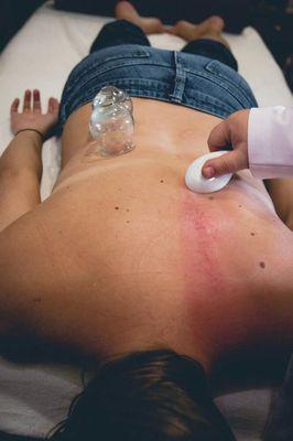 Photo credit: Forestt LaFave Gua Sha to help relieve tension in the upper back with cupping on low back