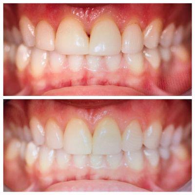 Replacement old veneers