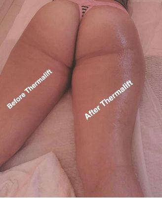 We only treated the Right side with Thermalift(RF) to show how quick you can see results from one session!