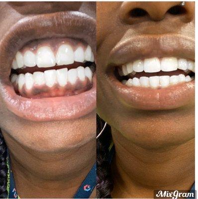 I received reshaping if my bottom 2 teeth, and a filling for a chipped tooth at the top. Amazing experience from Dr. Simpton.