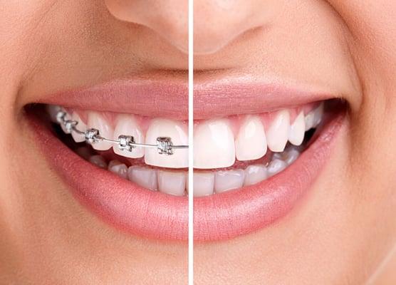 Invisalign Dentist