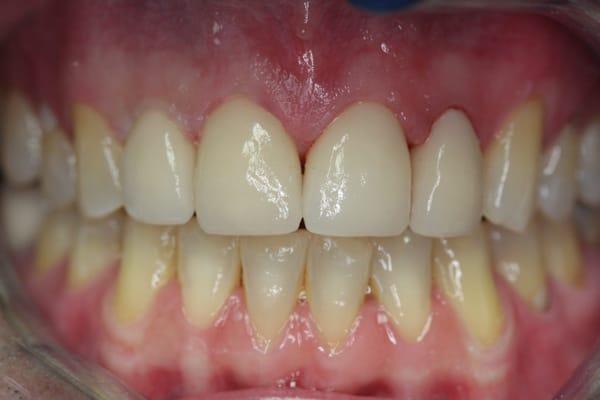 After photo of patient showing full coverage restorations (crowns) that restored function and drastically improved his smile!