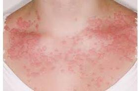 Allergic rash can appear anywhere