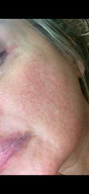 Skin catastrophe after one Laser Skin & Wellness Laser treatment.