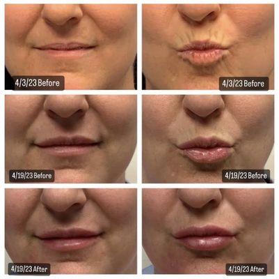 Juvederm Lip filler. 1st conservative treatment 4/3/2023, with refinement on 4/19/2023.