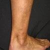 varicose veins after treatment