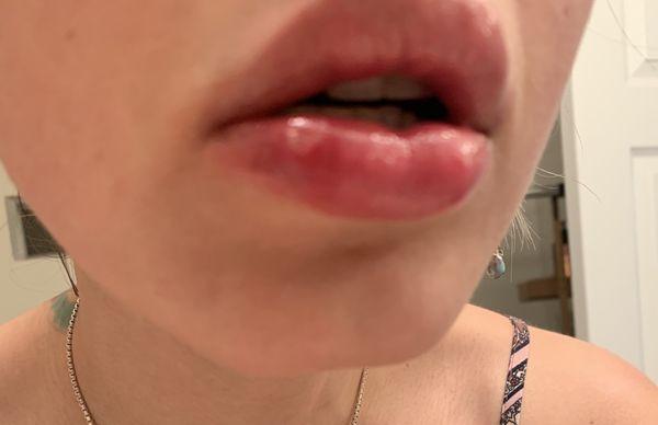 Busted and infected lip