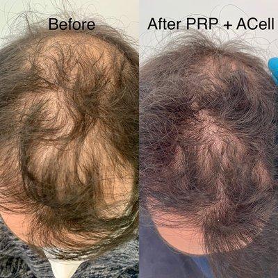 Before and after PRP with ACELL.  Combined with topical finasteride to get max results.