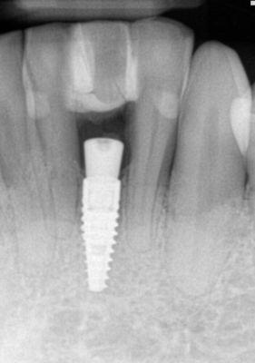 Dental implant replacing lower front tooth