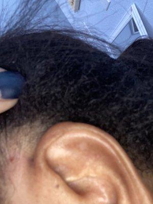 Rash above ear after perm was applied back in May 2021 . Hair Breakages itching & dryness .