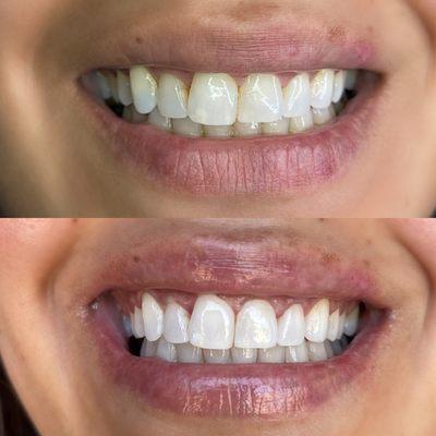 1hr whitening