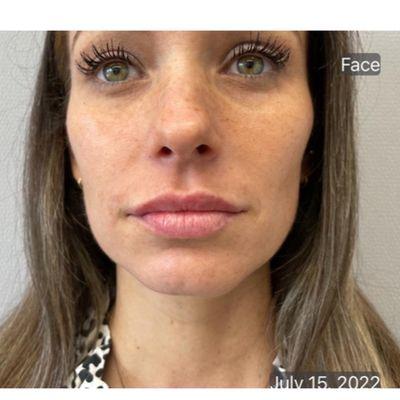 Immediately after having filler injections in lips and nasolabial folds