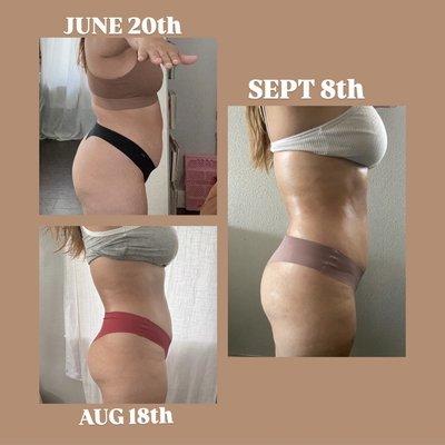 Body Sculpting! 
Before and After 
No Surgery