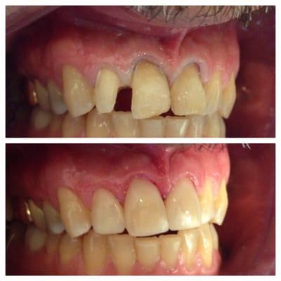 Bonding veneer in one visit without expensive crowns.  The true Minimally Invasive Dentistry!!!