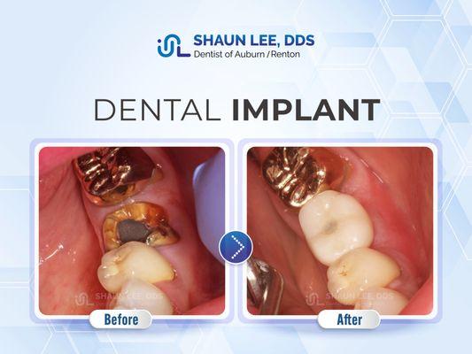 Shaun Lee, DDS Family Emergency Dental Implants of Renton | 10700 SE 174th Street, Suite 204, Renton, WA