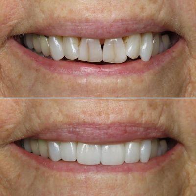 Smile makeover to fix fractured and misaligned front teeth completed by Dr. Rob