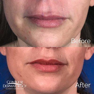 A lip lift shortens the skin between the nose and the upper lip that lengthens as we age. Making the face look years younger.