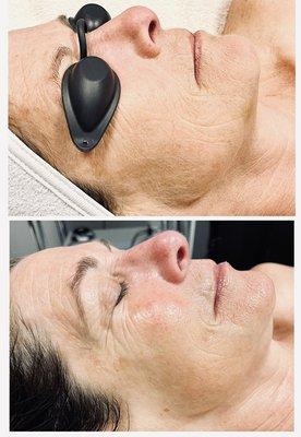 Dermaplaning facial