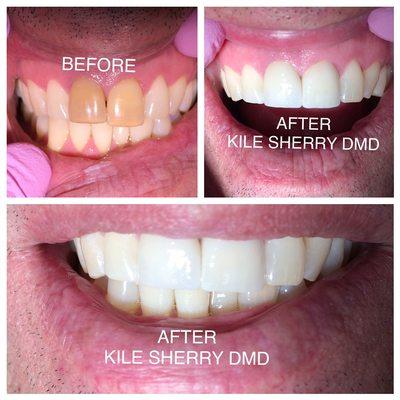 Cosmetic crown case completed by Dr. Kile Sherry