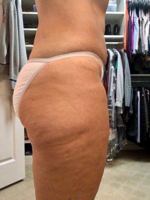 12/18 client after one full body supreme wrap. noticeable smoothing and cellulite reduction!