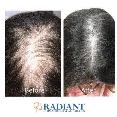 Female-Pattern Hair loss Before and After