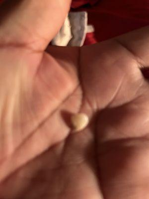 This is my cracked tooth