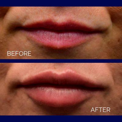 Before & After Lip Filler.