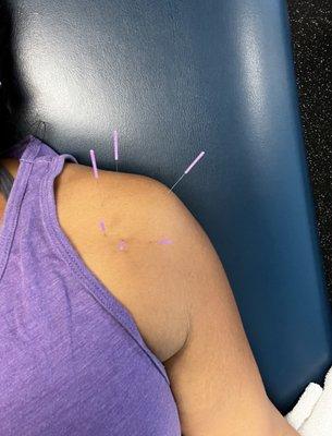 Dry needling