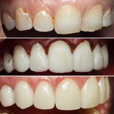 Cosmetic makeover involving gum re-contouring and veneers. Veneers made by our in-house lab with custom design.