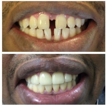 This patient of mine wanted to close his gaps with crowns  two visits he was very happy