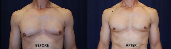 Gynecomastia Surgery Before and After Photos.