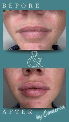 Lip enhancement with Restylane