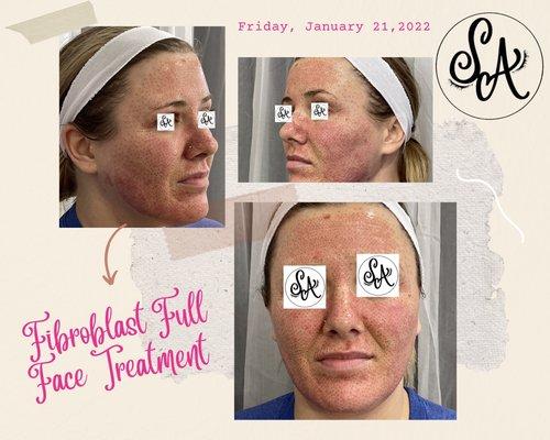 Full face rejuvenation for fine lines, wrinkles, scaring, texture changes, pigmentation and facial asymmetry.