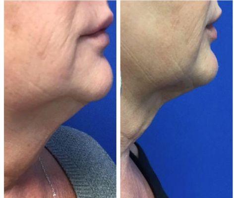 Kybella by Kristen.  Two treatments 6 weeks apart.  She is AMAZING and look at this FABULOUS result.