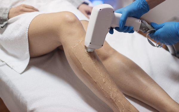 Laser Hair Removal