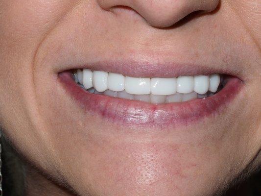 Another Smile rejuvenation! "I am smiling more!"- Stephanie