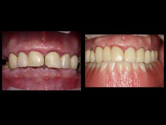 Implants and Crowns. Before and After.