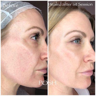 Microneedling every 4 -6 weeks is key to the aging process!