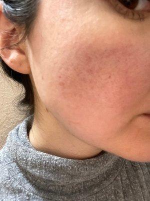 Acne scars before CO2 fractional laser...