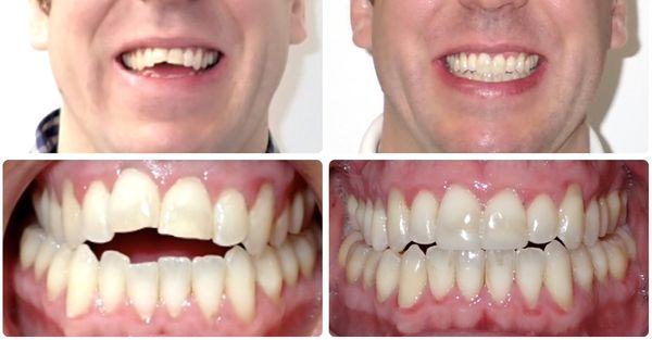 Complex treatment using only Invisalign aligners