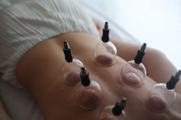 Cupping therapy uses the force of suction to pull blood toward the surface of your skin. The idea is to increase your body's natural healing