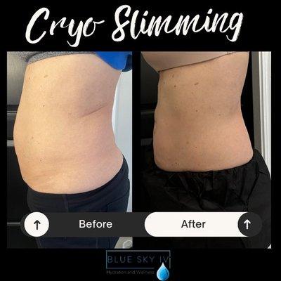 3 sessions of Cryo- Slimming