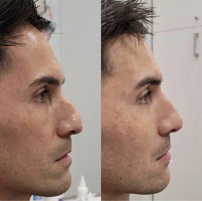 Liquid rhinoplasty aka nose filler done by Nurse Val