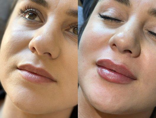 Lip filler before & after using Restylane Kysse