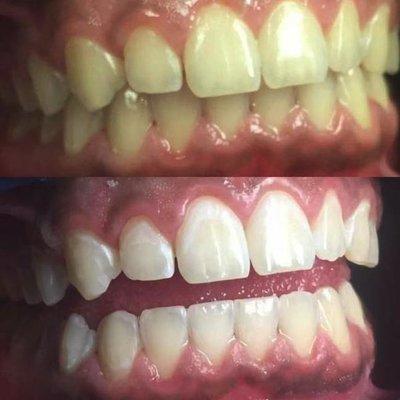 Before and after at NÜVA Smile | Teaneck, NJ