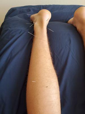 Acupuncture for Achilles Tendon Pain!