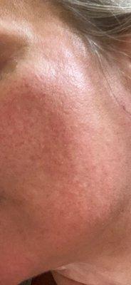 Skin catastrophe after one Laser Skin & Wellness Laser treatment.